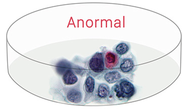abnormal cells - advanced