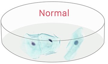 abnormal cells - mild