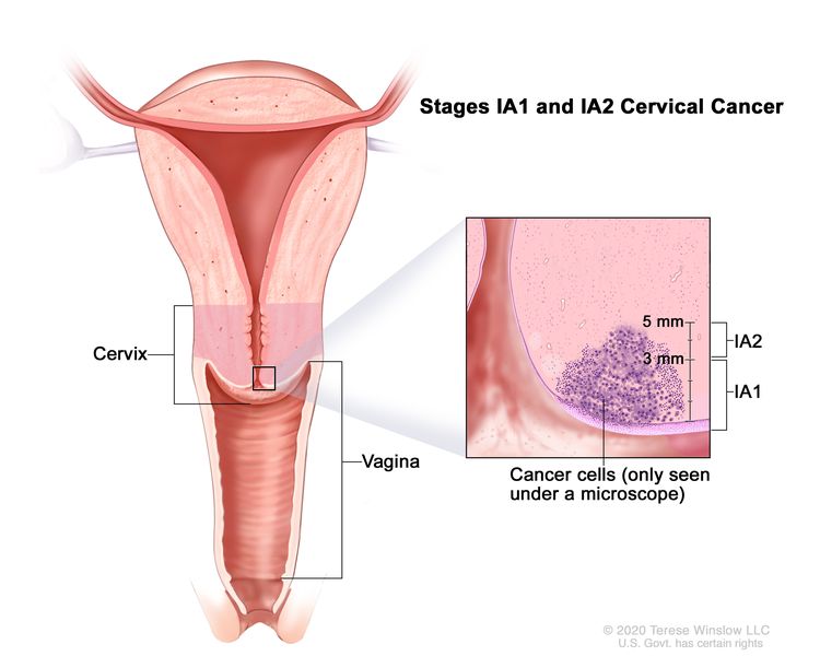 Cervical cancer stage 1