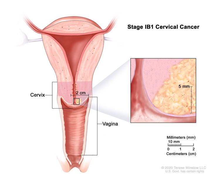 Stage 1b