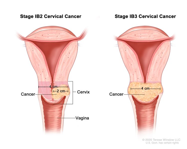 Stage 1b2