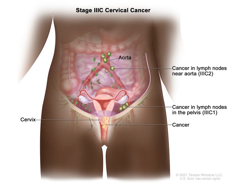 Stage 3c