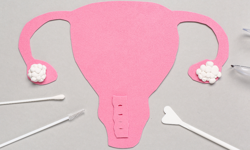 Read more about the article New Option for Cervical Cancer Screening — Self-Collected Samples