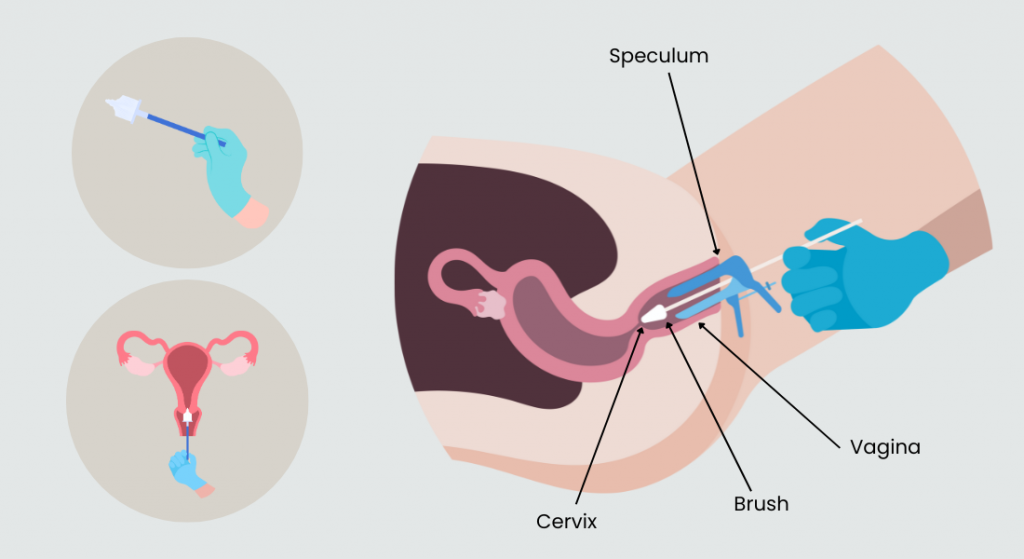 Pap and HPV test